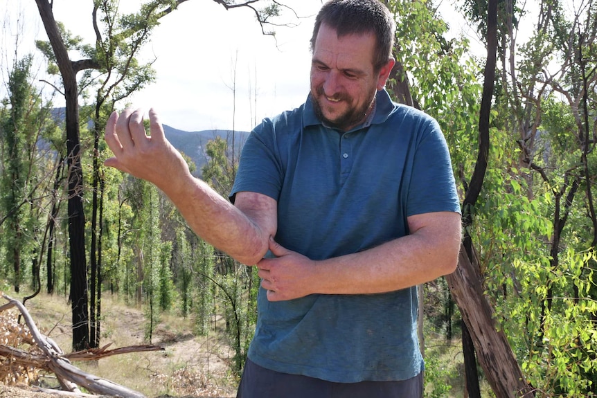 A man holds up his arms to show scarring from burns.