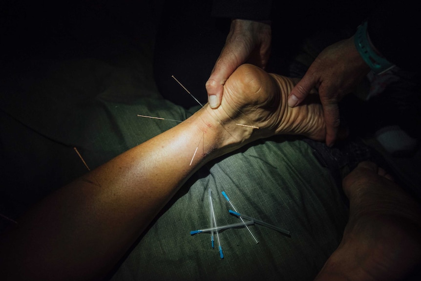 Hands holding ankle as dry needling is inserted