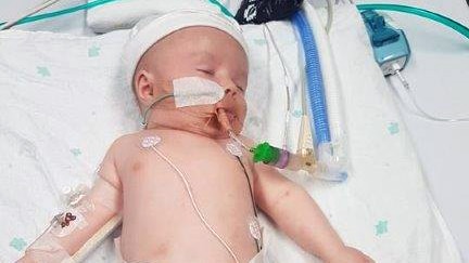 A baby lies in hospital surrounded by breathing tubes and other medical equipment