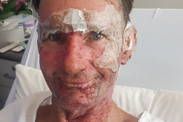 Man smiling in hospital bed with partially bandaged face and red burn marks on face