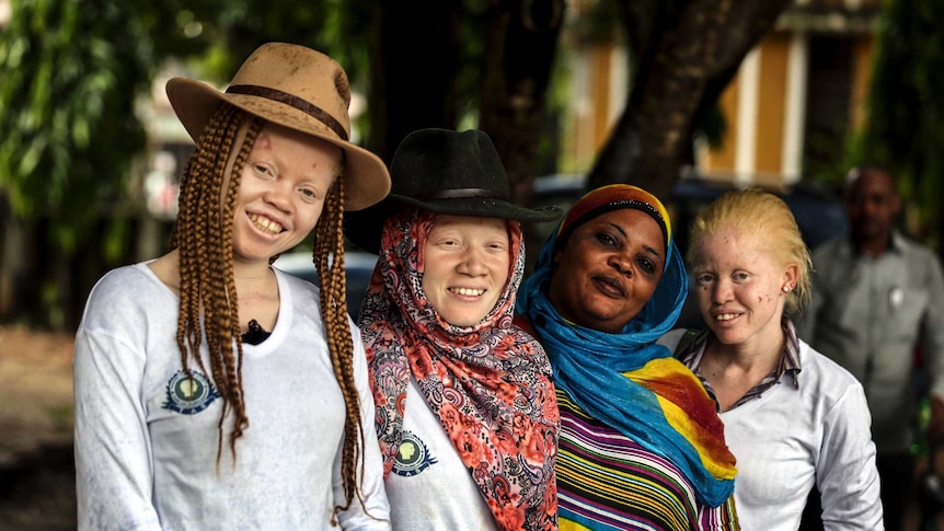 albino women in Tanzania