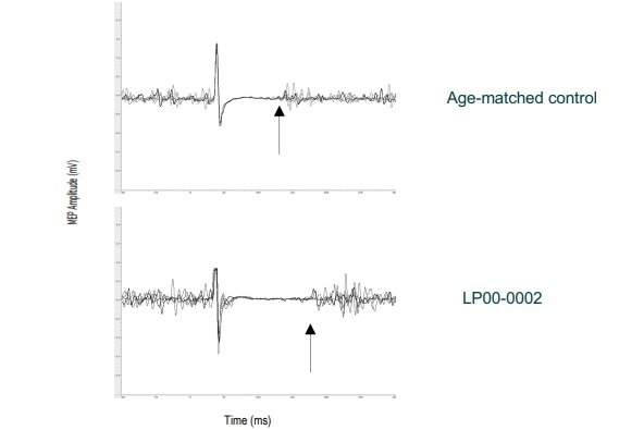 Graph of Lydia Pingel's neurological testing, below, a lot more busy compared to someone who has not played sport, above,