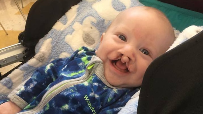 Baby Charlie Halliday smiling at the camera after an operation on his cleft palate