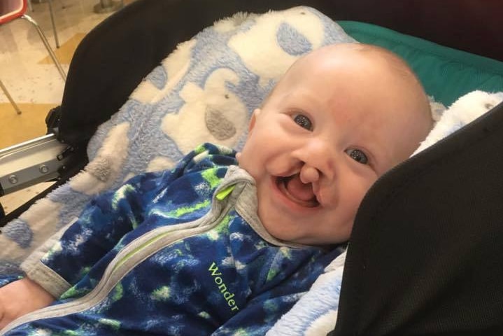 Baby Charlie Halliday smiling at the camera after an operation on his cleft palate