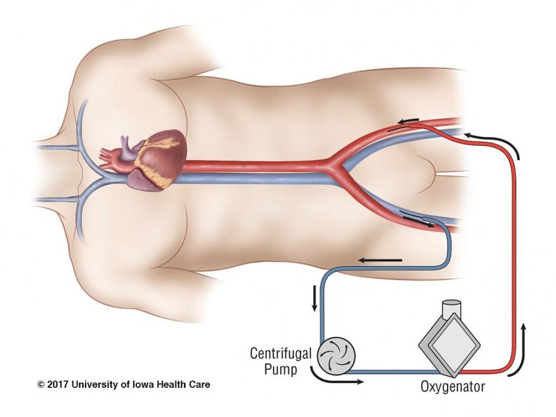 Veno-arterial ECMO