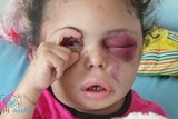A young girl tried to open her eye with her hand after she is injured in an air strike in Yemen.