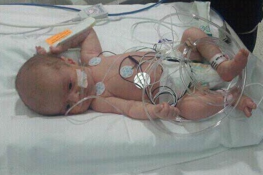 A baby laying on a hospital bed wearing a nappy and covered in wires