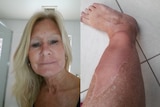 A photo of Deborah Rundle next to an image of her scared leg.