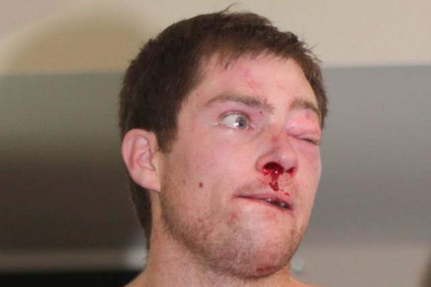 A man with swollen eye and bleeding nose
