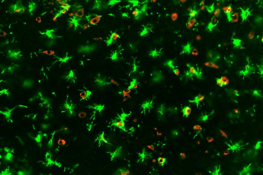 Brain cells of a COVID-19 infected mouse showing 'angry' microglia in green, and SARS-CoV-2 in red.