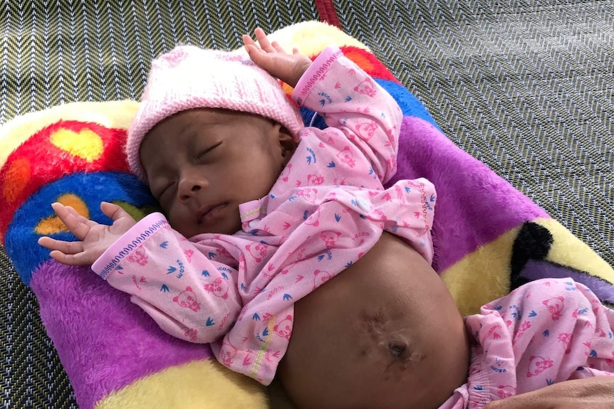 A newborn baby with its distended stomach exposed with scars on it