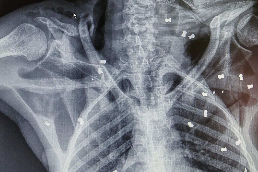 An x-ray of a orangutan's chest with several bullets lodges randomly throughout its torso.