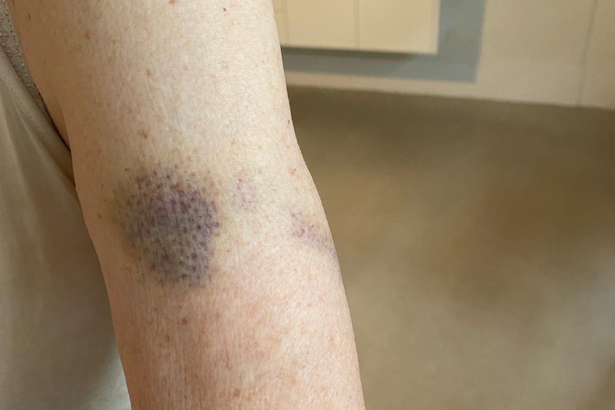 Arm with purple bruise