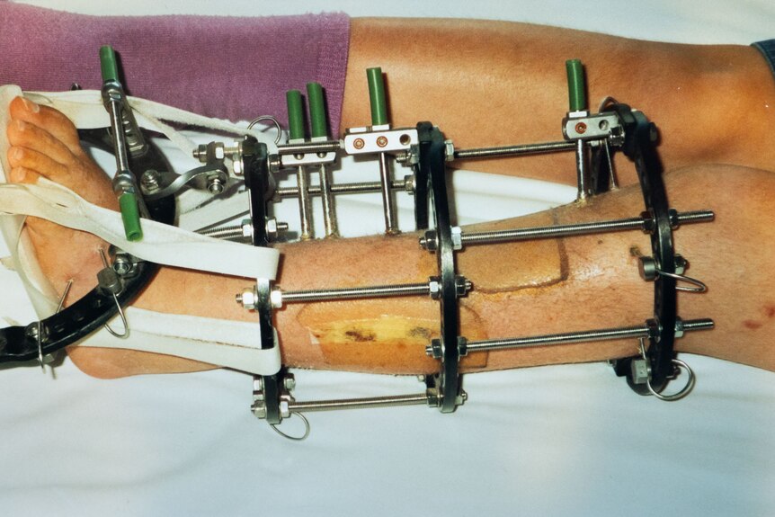 A leg resting on hospital bed with painful looking metal frame holding surgical rods in place
