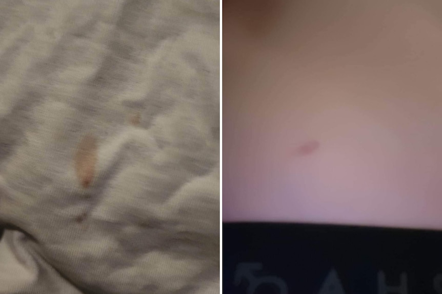 Left side shows white, crumpled short with red small blood spot, the right shows skin with a red circle 