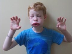 Ryan Bogoyevitch, 12, in the midst of an attack from hereditary angioedema.