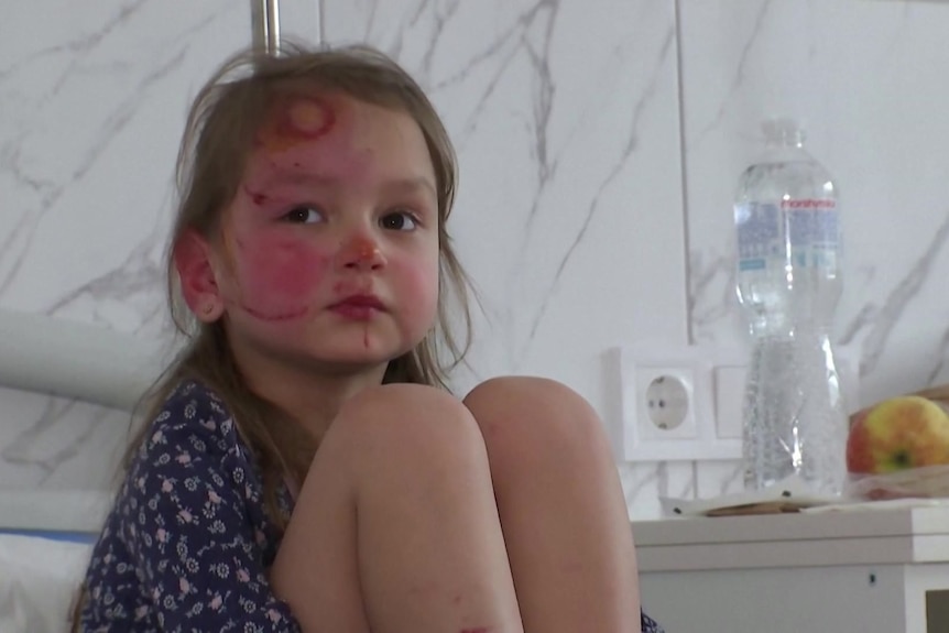 A child with light burns on her face.