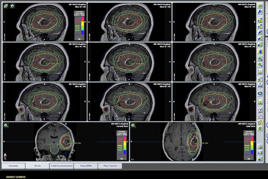 A series of scans showing Jen Barnes' brain tumour