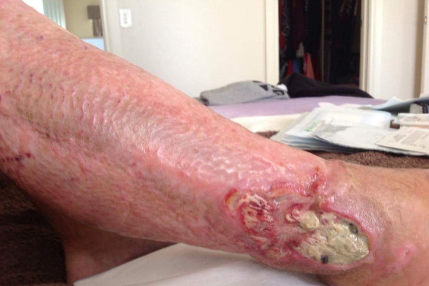 Leg with infected wound