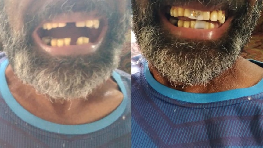 A composite photo showing before and after a person received imitation orthodontics. 