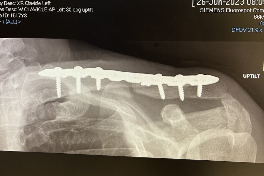 A black and white x-ray of a collarbone, with a bright white object with screws inside.