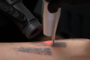 Close-up of Laura Kennedy's tattoo being lightened