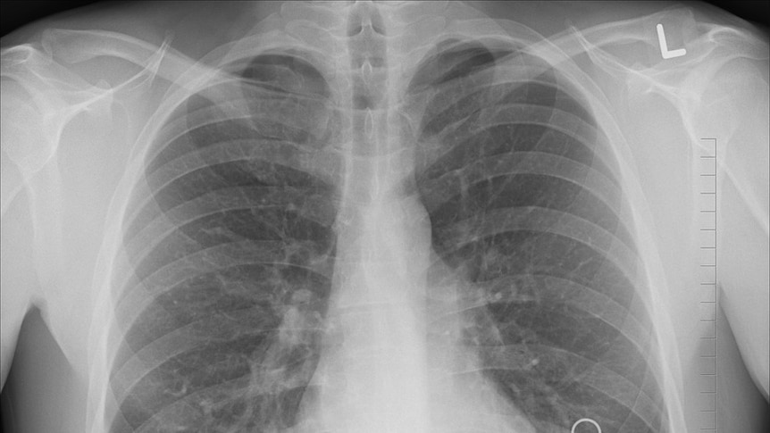 xray of lungs