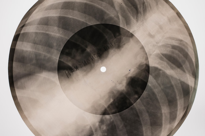 A chest X-ray cut into a circular disc 
