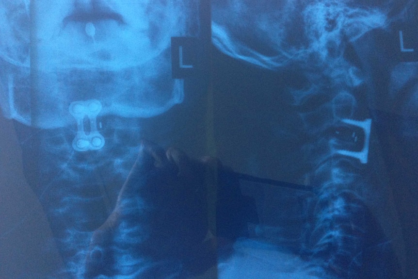 Peter Gee post op spinal fusion x-ray