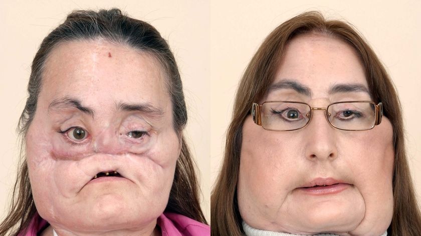Before and after photos of Connie Culp