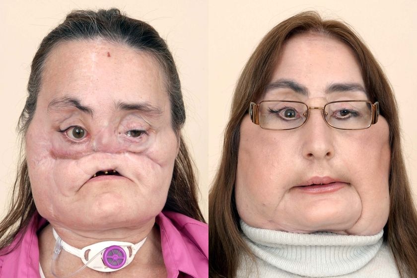 Two photos: one of Connie Culp before surgery and the second is after ground-breaking surgery.