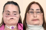 Before and after photos of Connie Culp