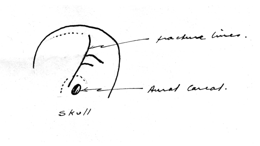 A line drawing pointing out fracture lines on a skull.