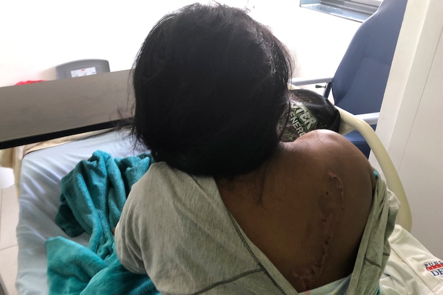 A woman's back with injuries, she is sitting on a hospital bed and her face in not visible in the image.