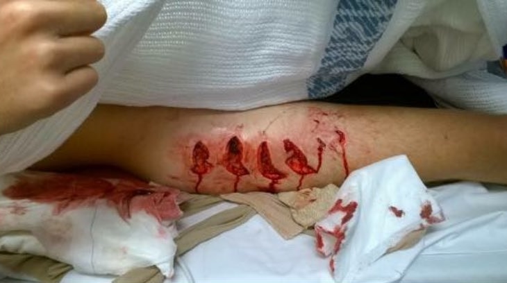 Cooper's injured leg after he was bitten by a shark.