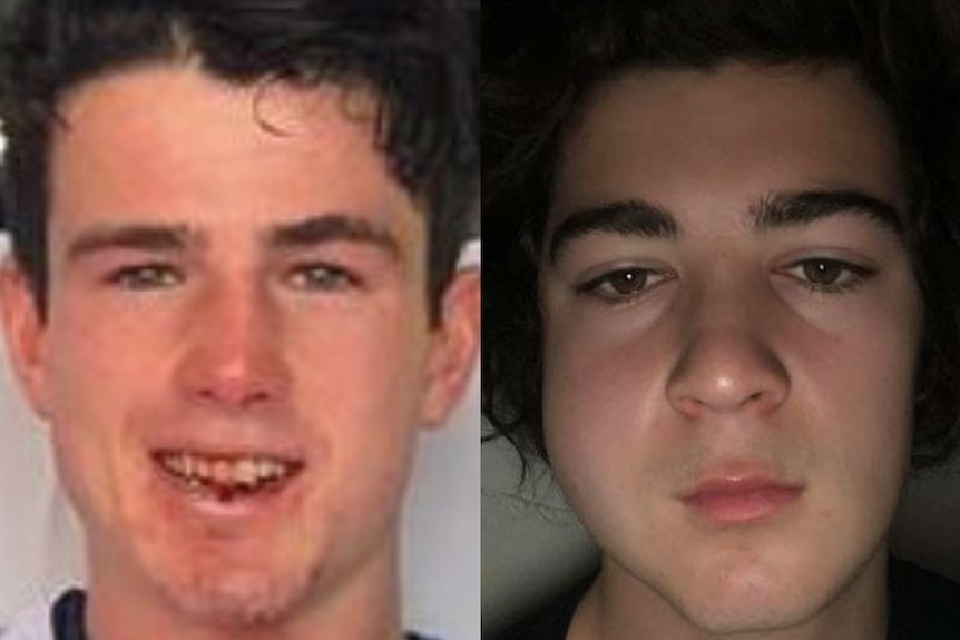 A split image showing two young footballers with broken jaws.