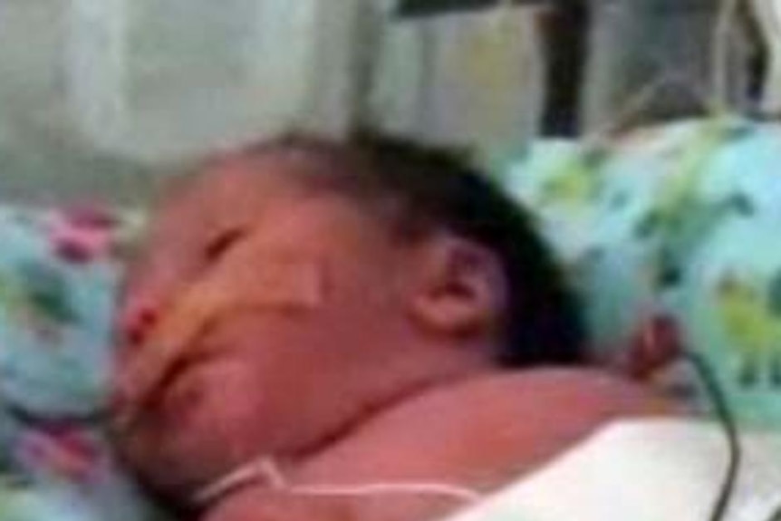 Baby in hospital suffering from the condition gastroschisis.