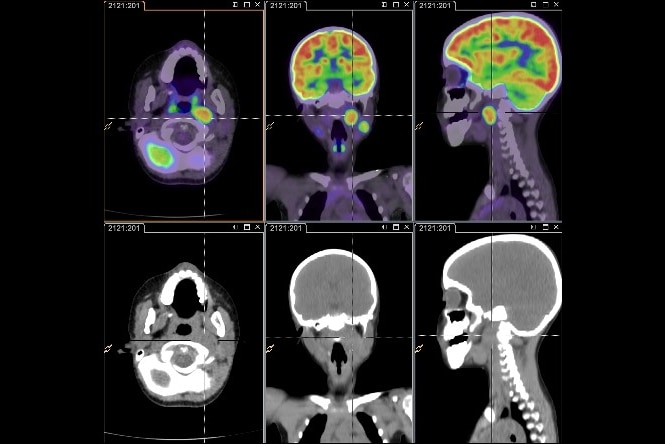 Scans show the location of a tumour in Freyja's head, and the absence of the tumour following its removal.