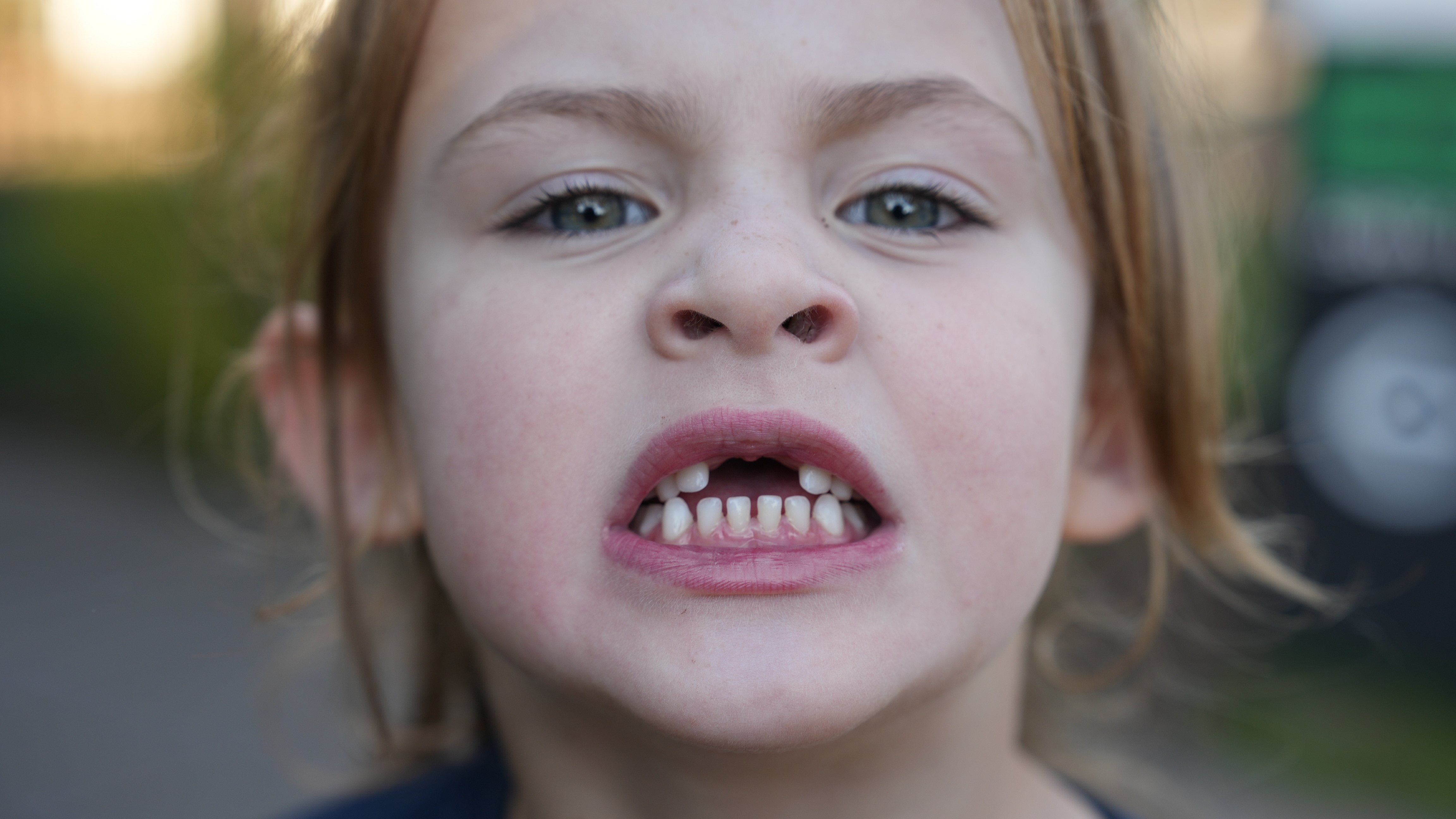 A little girl grimaces showing her missing front teeth.