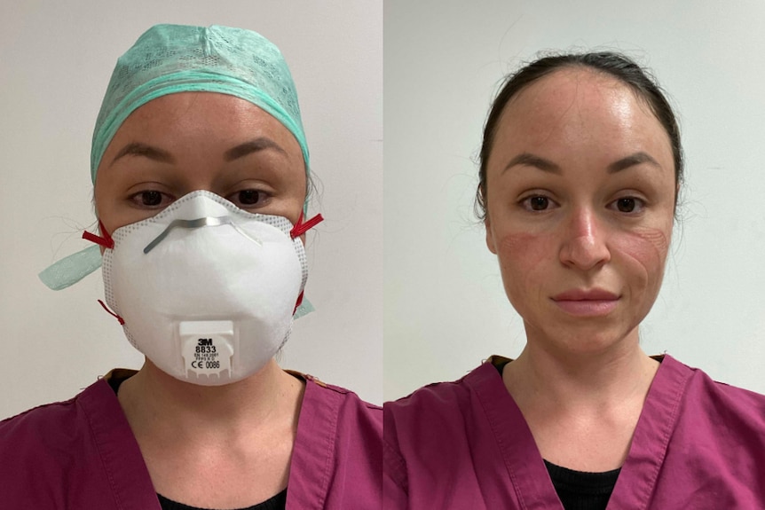 Side by side photos of the same nurse show her wearing PPE (a face mask, cap, scrubs), and without it, her face covered in marks