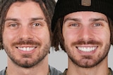 A before and after shot showing a close-up of Jayden Vilardi before and after he had eight veneers fitted to his top teeth.