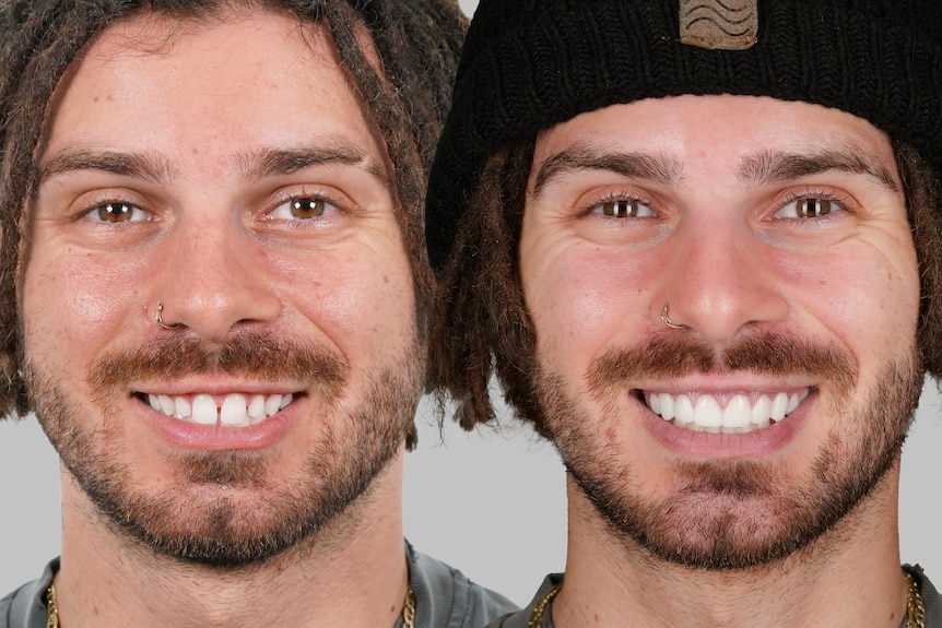 A before and after shot showing a close-up of Jayden Vilardi before and after he had eight veneers fitted to his top teeth.