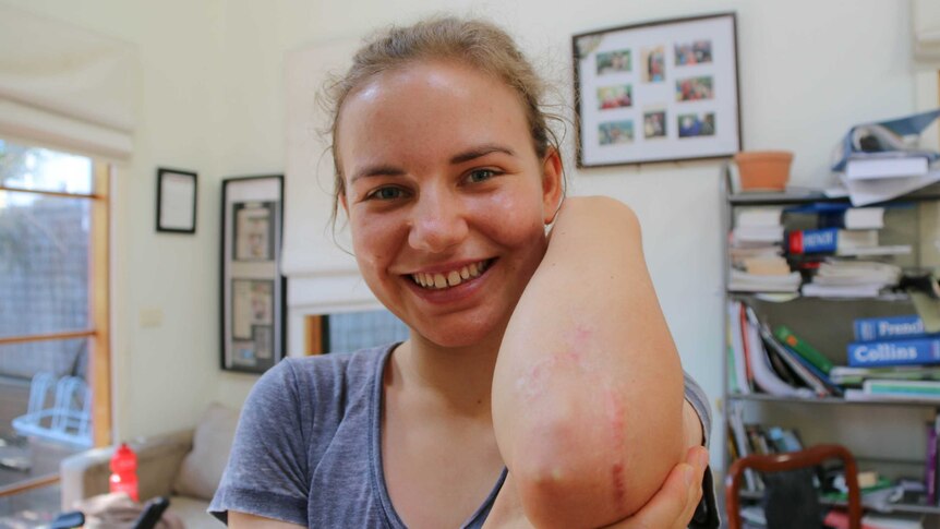 Sarah Gigante shows a scar on her elbow from a cycling crash.