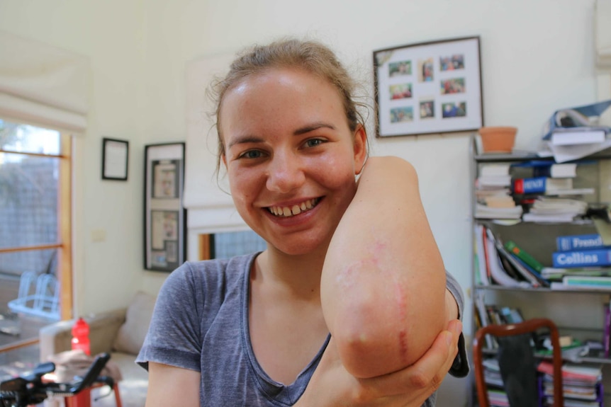 Sarah Gigante shows a scar on her elbow from a cycling crash.