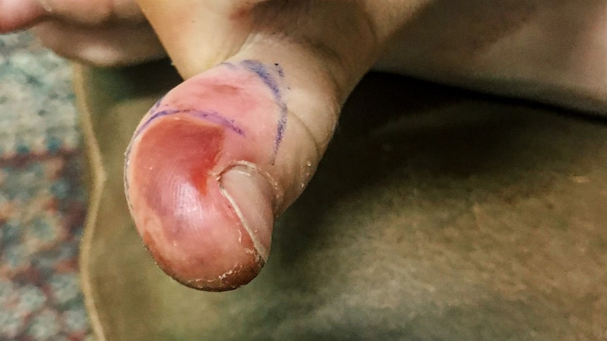 A bruised toe.