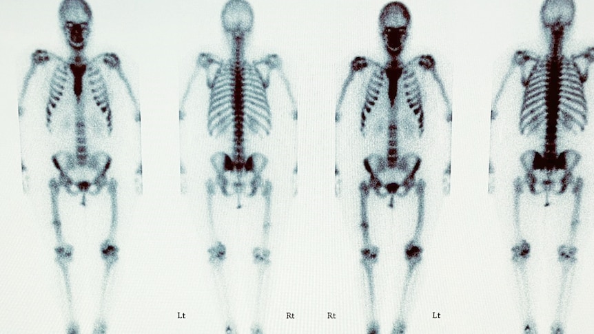 X ray images of full body scan of adult woman.