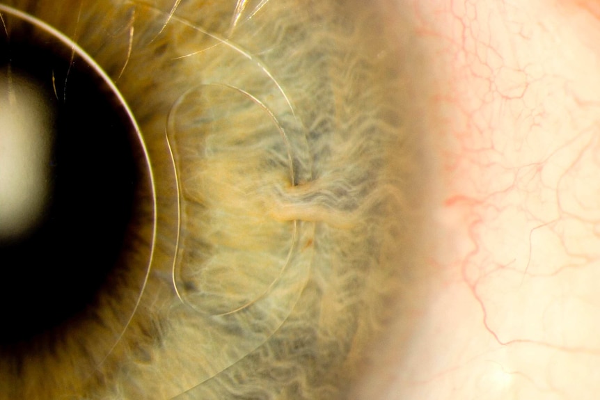 Intraocular lens 'iris clip'