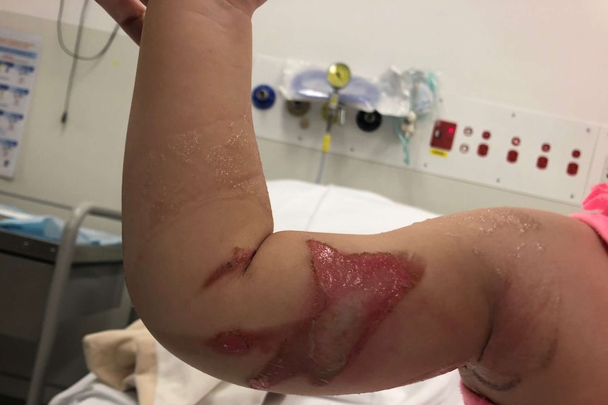 a young girl's arm affected by burns