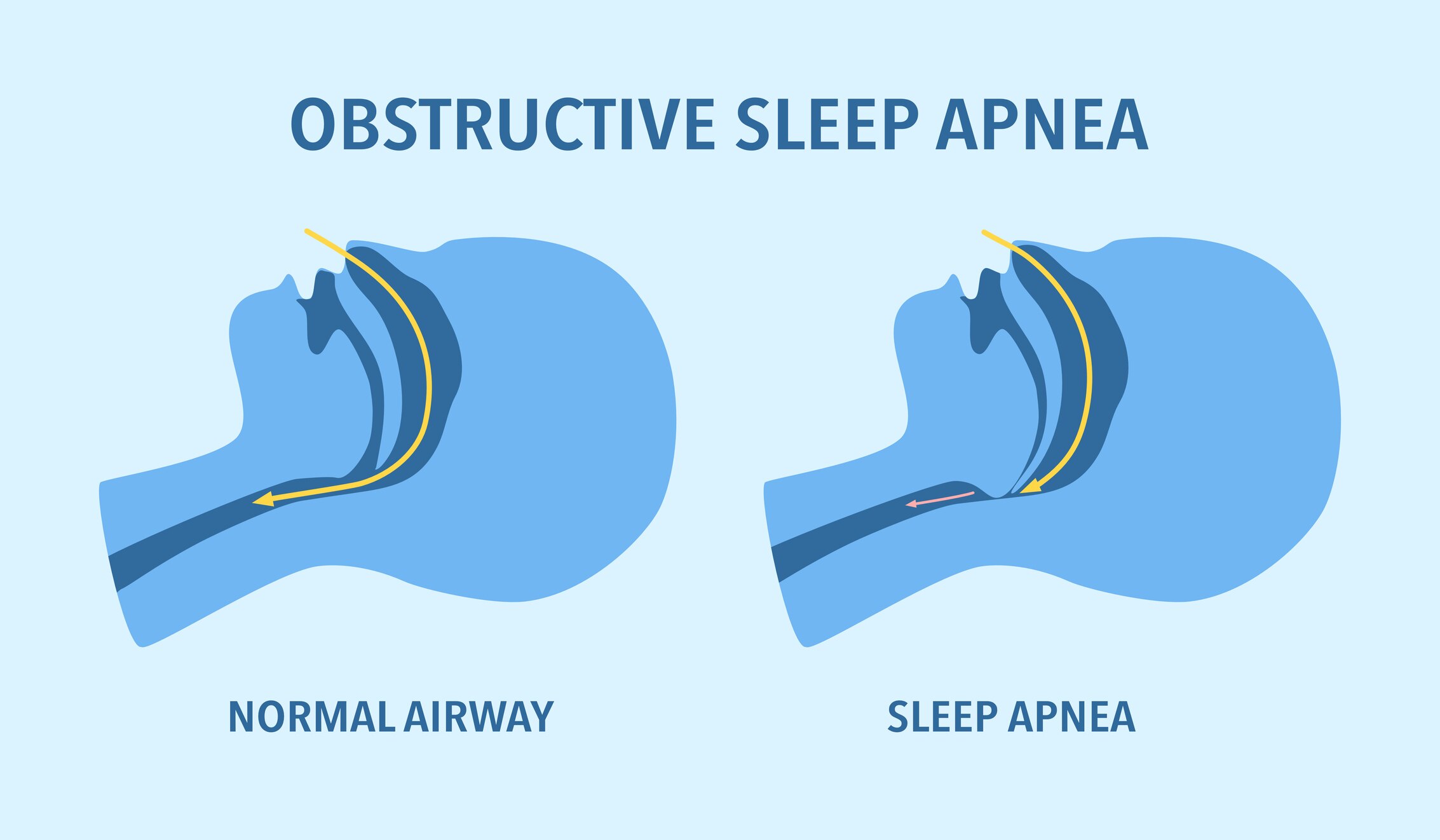 A diagram showing a normal airway next to one affected by sleep apnoea