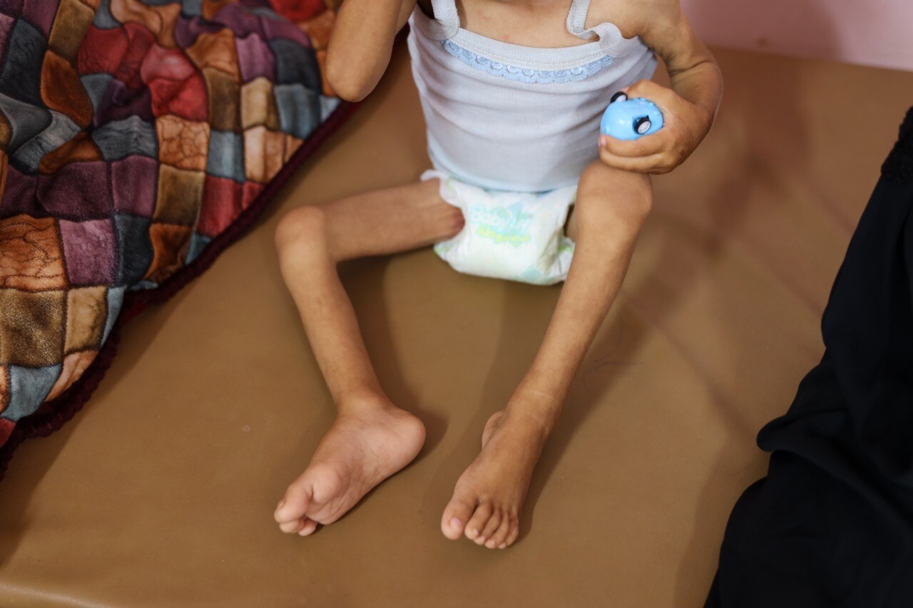 The legs of an emaciated child